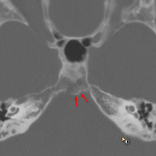 Ecchordosis Physaliphora