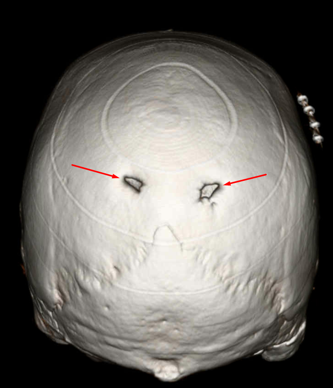 Enlarged Parietal Foramina