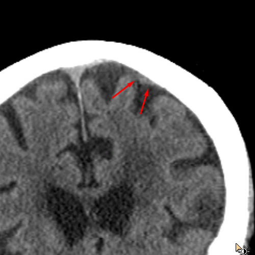 cortical-vein