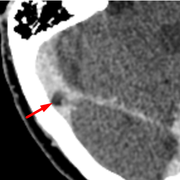 arachnoid granulation