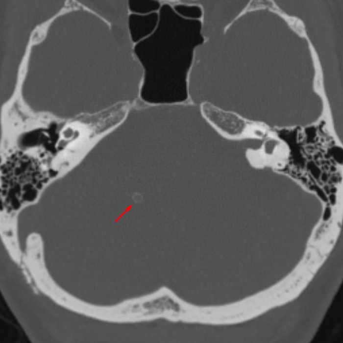 calcified-choroid