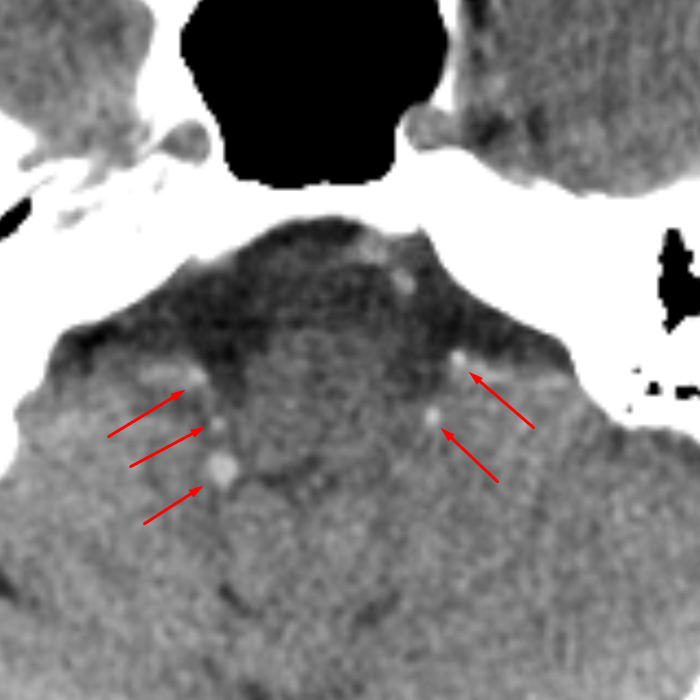 choroid-lushka