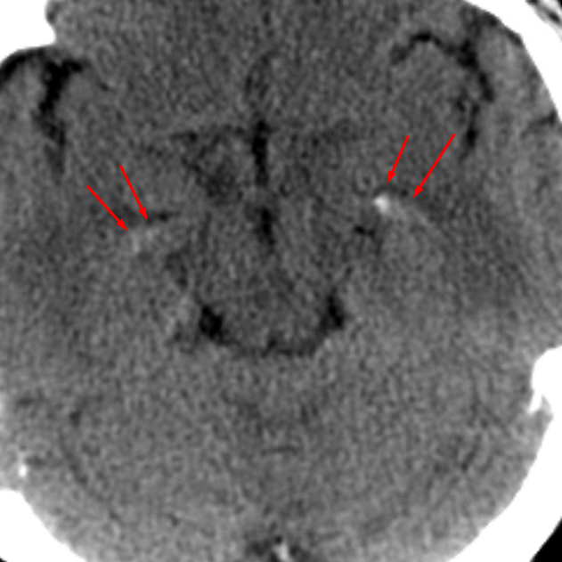 choroid-temporal-horns