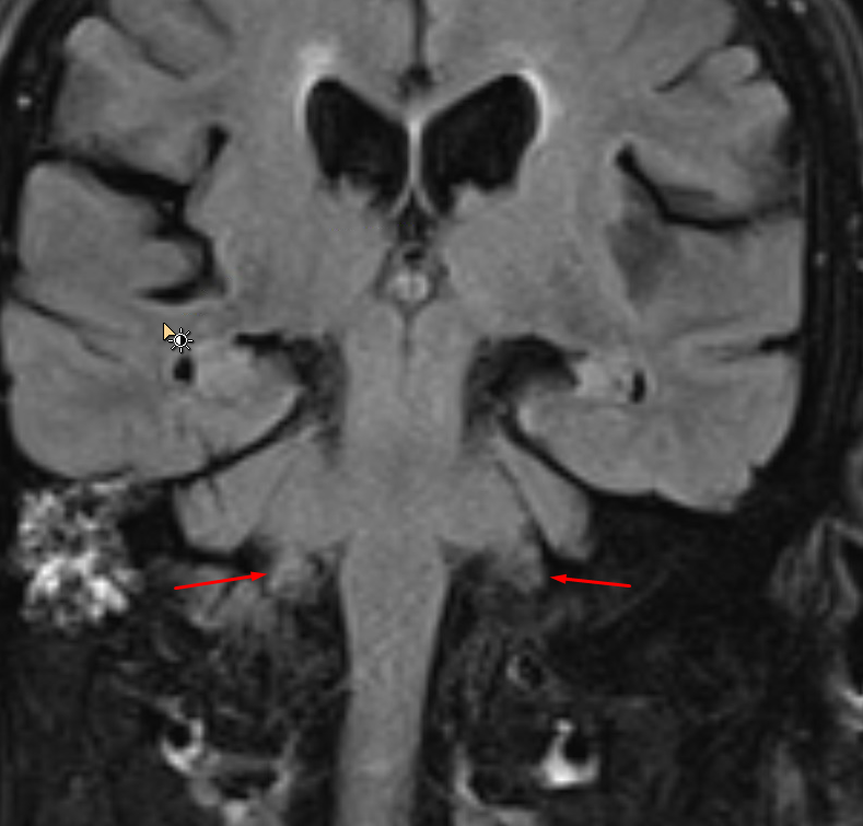 flocculus on mri