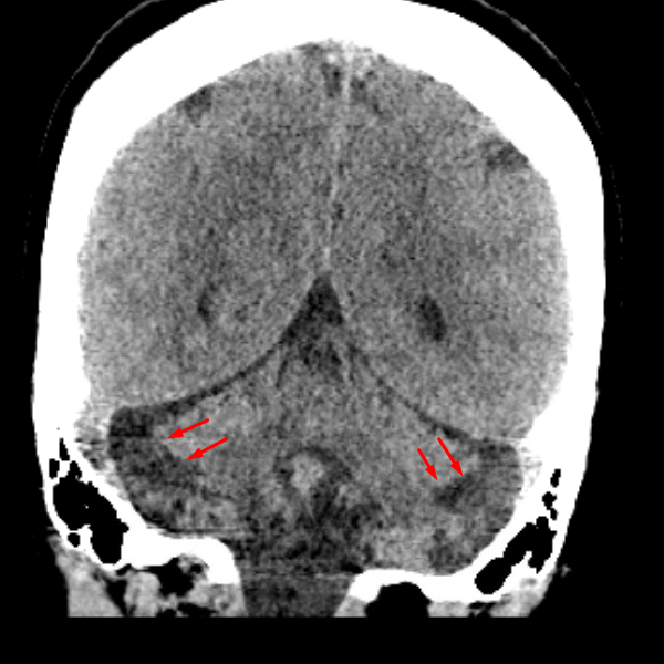 horizontal-fissures-coronal