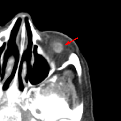 inferior-oblique-mass