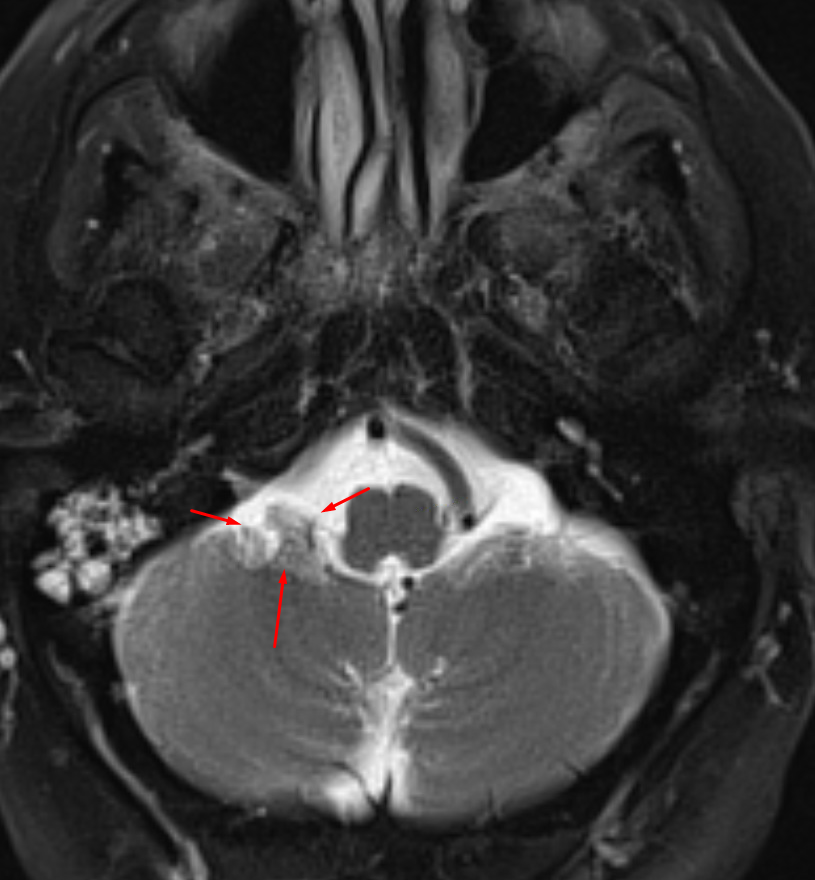 mri flocculus axial