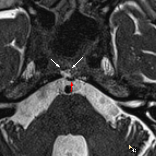 mri