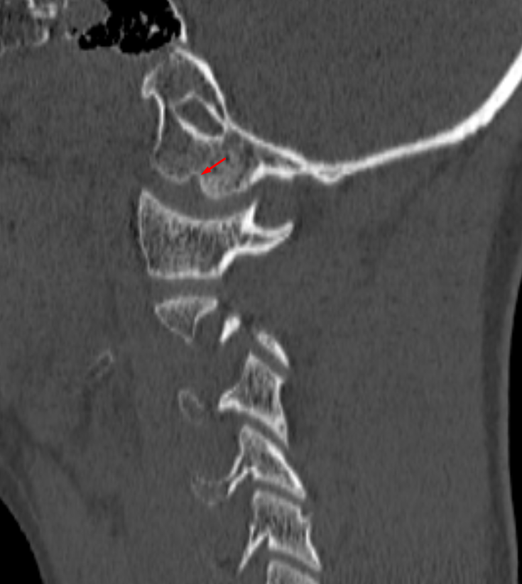 occipital condyle notch