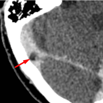 Arachnoid Granulation
