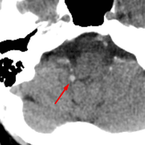 Choroid Plexus in Foramina of Luschka