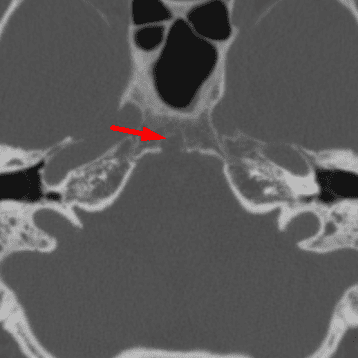 Ecchordosis Physaliphora