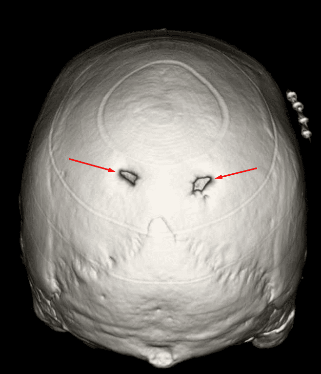 Enlarged Parietal Foramina