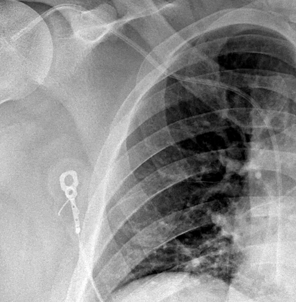 Central Venous Catheter Overview