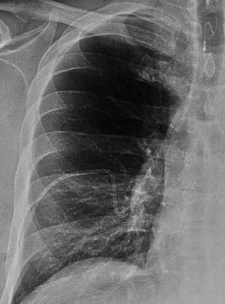 syringopleural shunt | CaseStacks.com