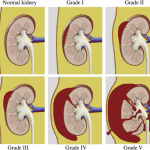 classification of renal lacerations