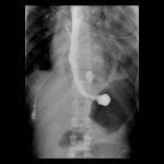 Extraluminal contrast, confirming the diagnosis of Boerhaave's syndrome.