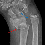 Galeazzi fracture/dislocation with a distal radial fracture (red arrow) and distal dislocation of the ulna (blue arrow) with widening of the distal radioulnar joint.