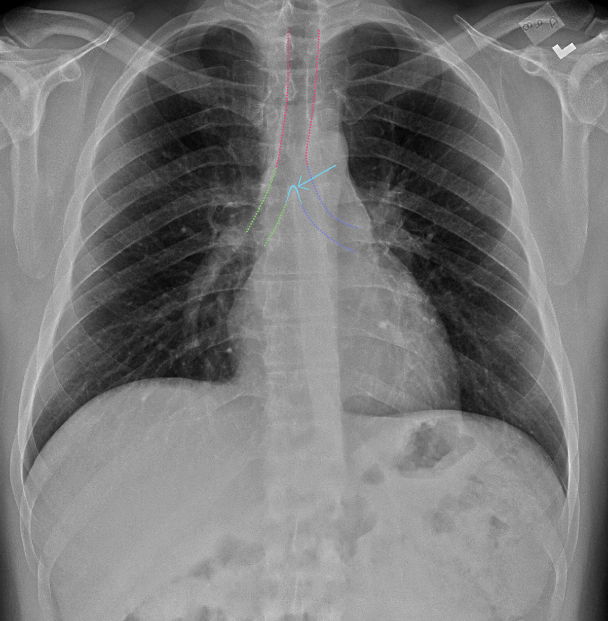 Chest X-Ray Anatomy