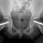 Postop radiograph in this patient with similar alignment of the femoral heads.