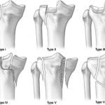 Schatzker classification