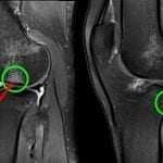 Green circles: Kissing lesions; Red arrow: Osteochondral fracture