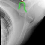 Green outline: coracoid process; aka “Lighthouse of the shoulder”