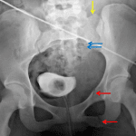 Stable pelvic ring injury (LC I) with left obturator ring fractures (red arrows) and left sacral fracture with slight offset of the left sacral ala (yellow arrow) and several arcuate lines (blue arrows).