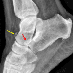 CaseStacks.com — Case #7 — Anterior process of calcaneus fracture and ...