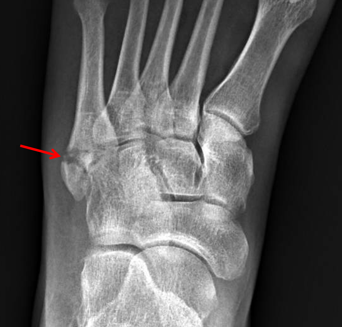 displaced 5th metatarsal fracture