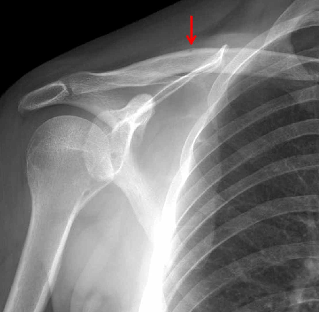 A Pre Operative X Ray Showing Right Clavicle Midshaft Fracture Allman ...