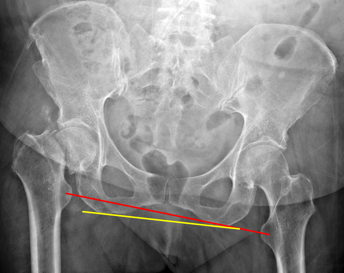 normal hip xray femoral neck fracture xray