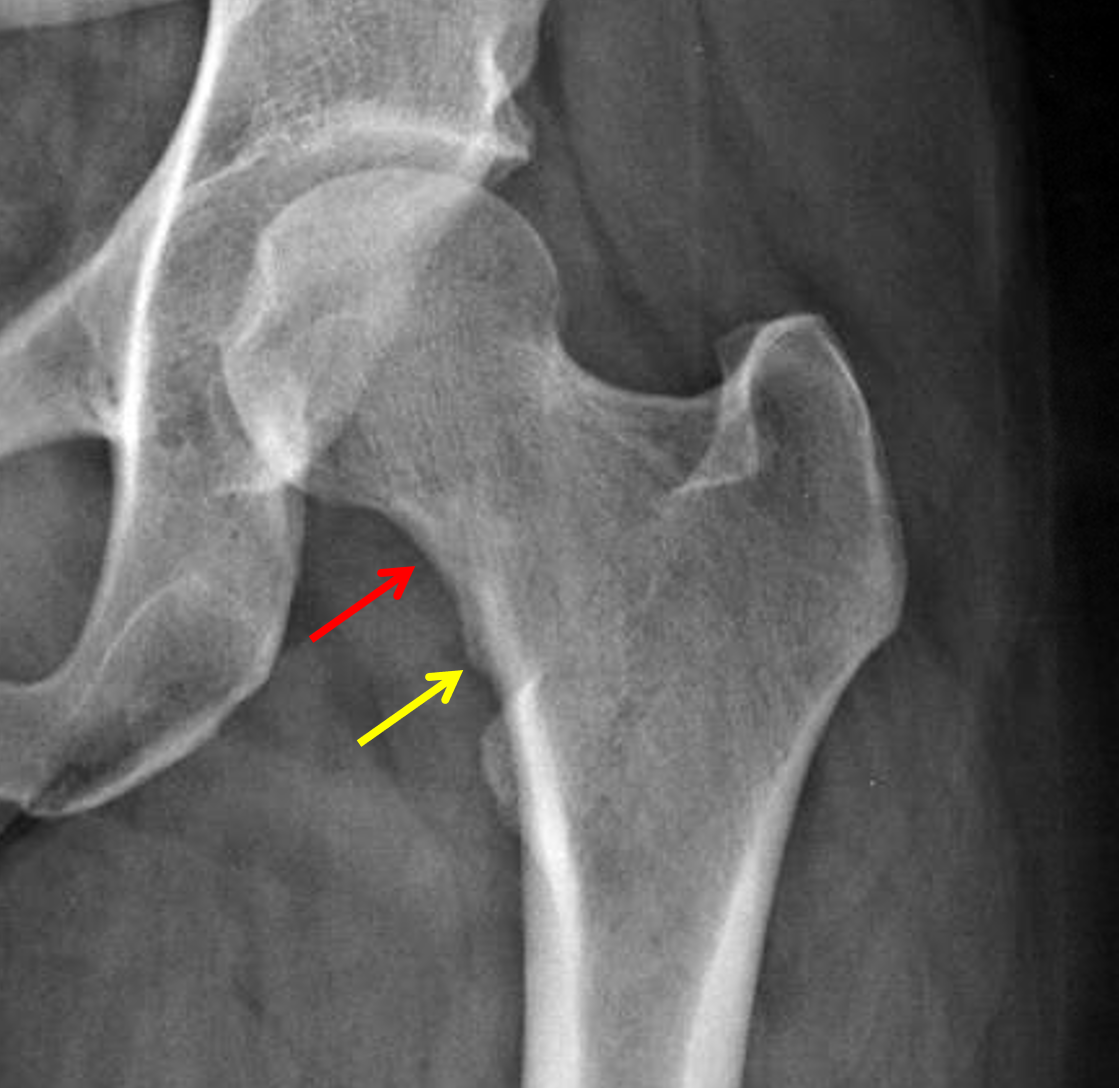 Imaging Of Femoral Acetabular Impingement Syndrome St - vrogue.co