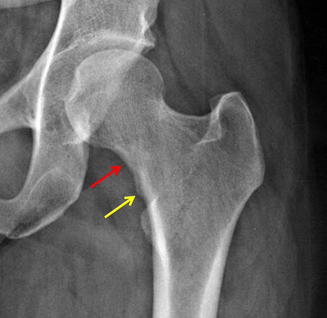 Femoral Neck Stress Fracture MRI