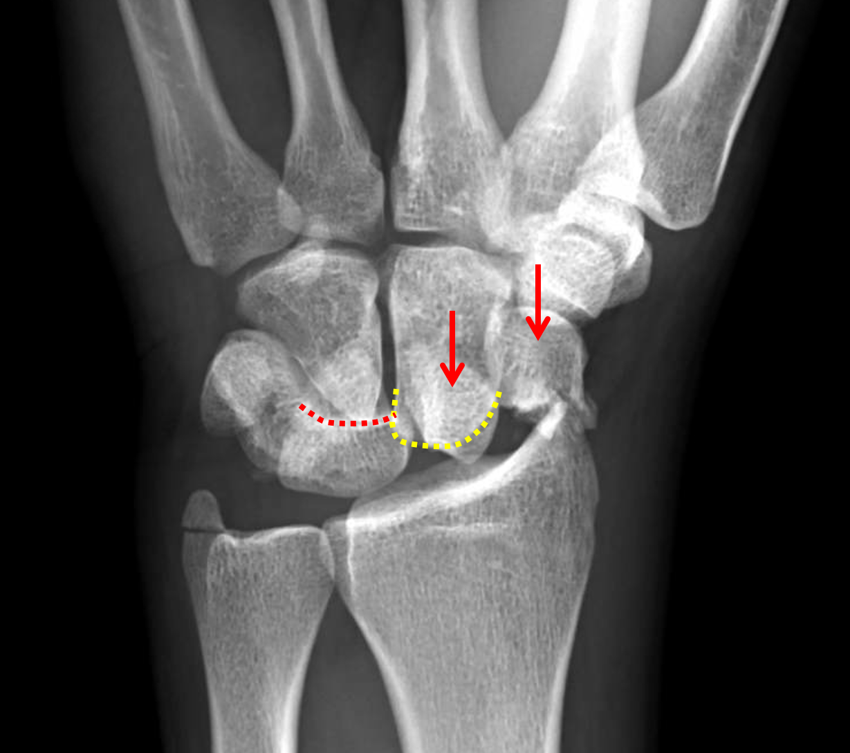 scaphoid fracture x ray