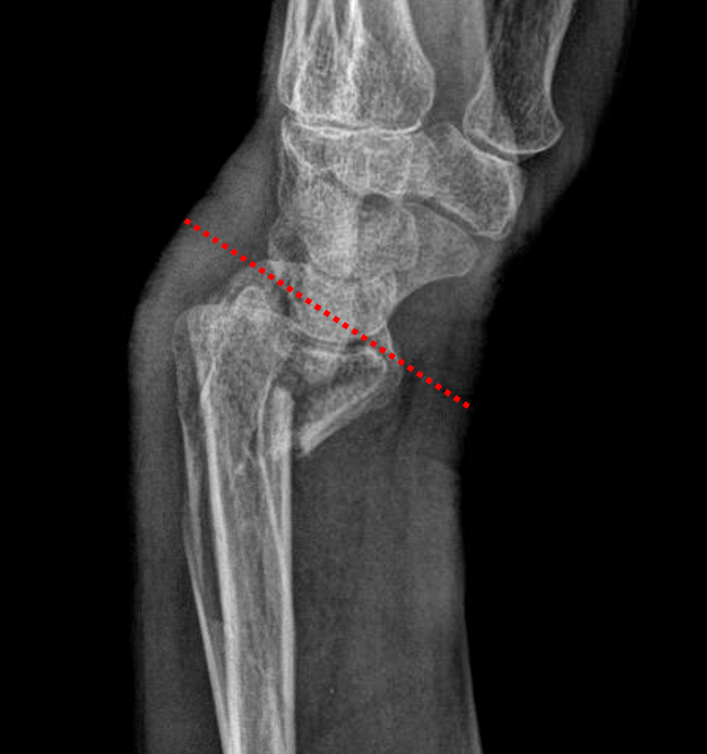 smith fracture nerve