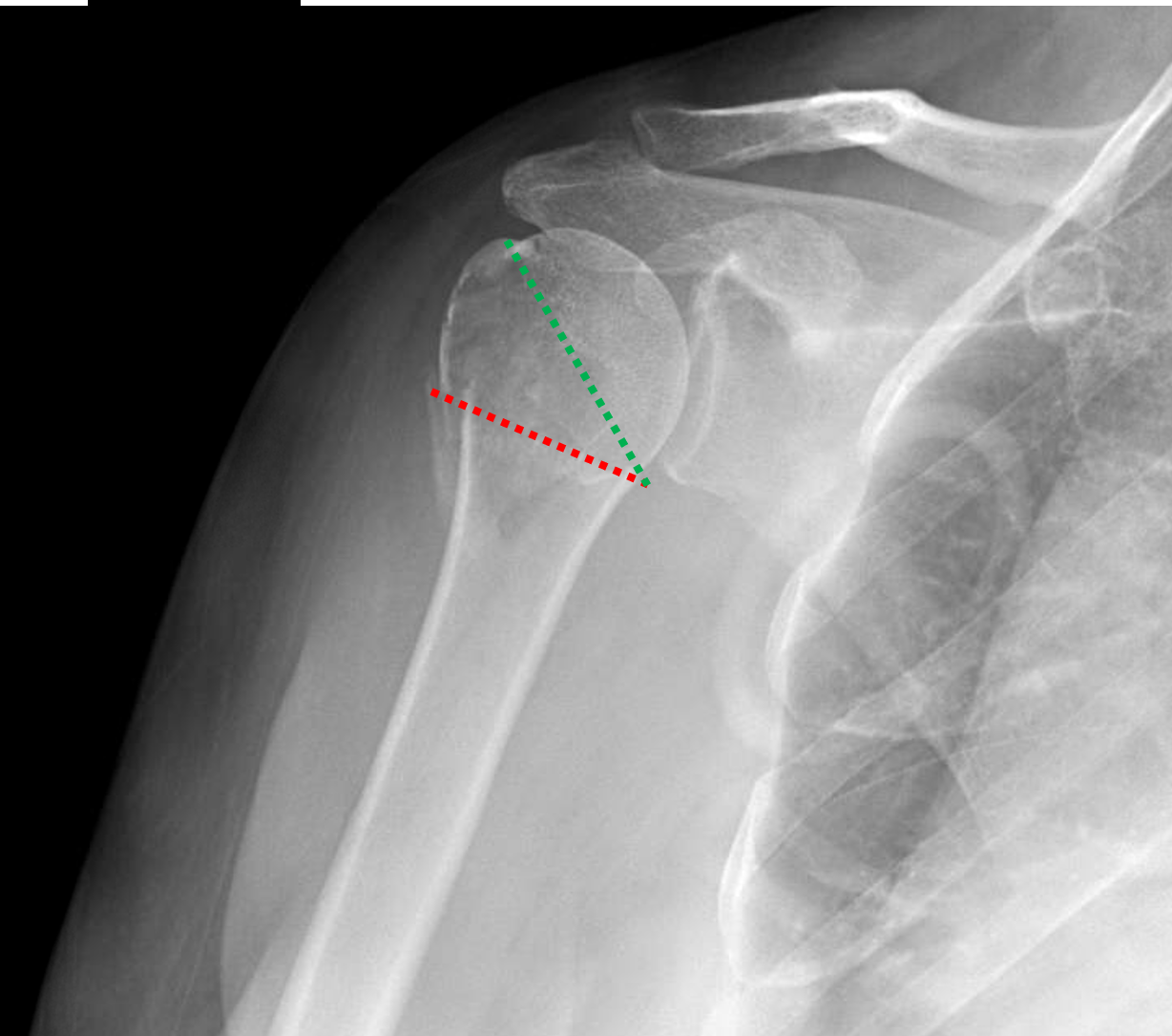 Proximal Humerus Surgical Neck Fracture