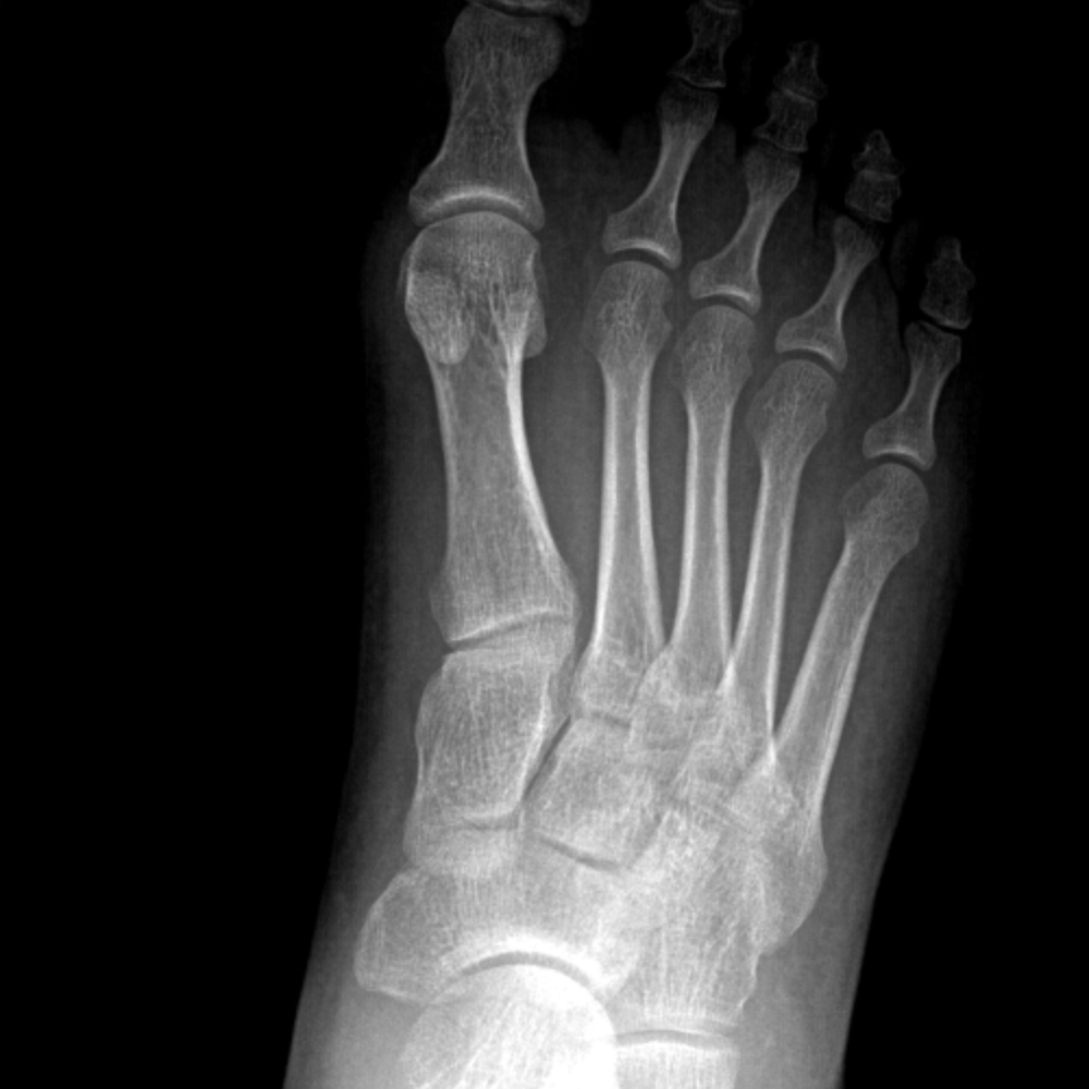 Dorsal Talar Avulsion Fracture