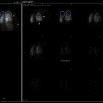 Blue circles show decreased activity in both upper lungs related to soft tissue attenuation. Red arrows show large segmental perfusion defects which are not matched on ventilation (yellow arrows).