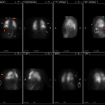 Red arrows show large segmental defects in the right lung in multiple projections. Orange arrows show activity in the thyroid and stomach related to free pertechnetate. Pink circle shows the site of IV infiltration.