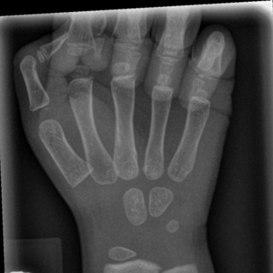 buckle fracture thumb