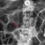 Linear lucency along the inferior wall of the proximal transverse colon concerning for pneumatosis (red arrows).