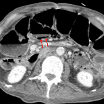 Pneumatosis of the proximal transverse colon confirmed on the subsequent CT (red arrows).