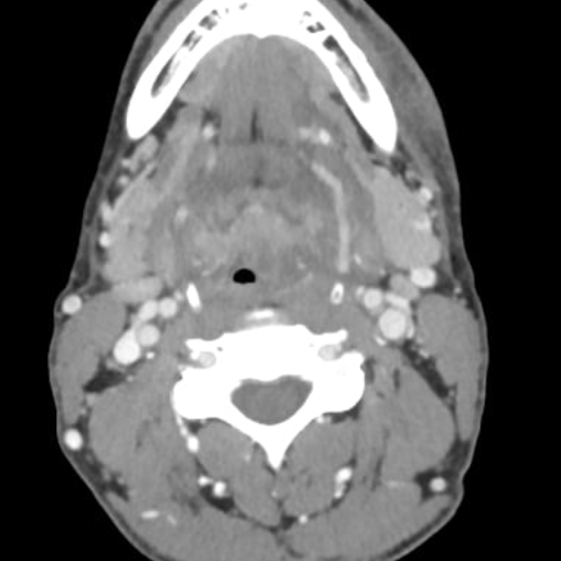 Emergency Neuroimaging – Face/Neck