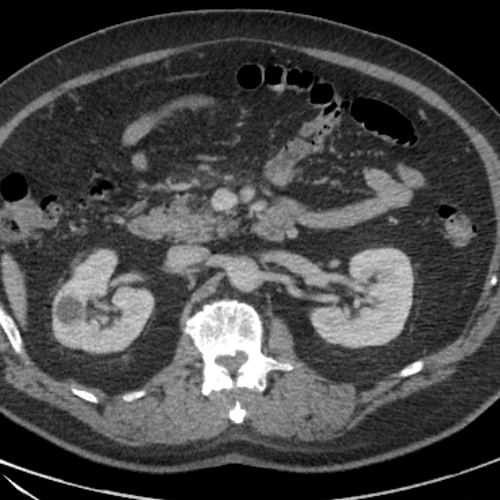 CaseStacks.com — Case #74 — Meckel diverticulitis