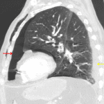 Hemopneumothorax with gas layering anteriorly (red arrow) and fluid layering posteriorly (yellow arrow) in this supine patient.