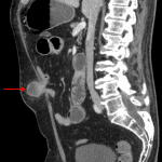 Herniation of a loop of small bowel through a small midline incisional hernia (red arrow).