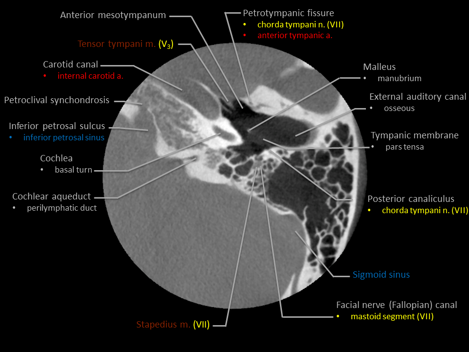 Chorda Tympani Petrotympanic Fissure