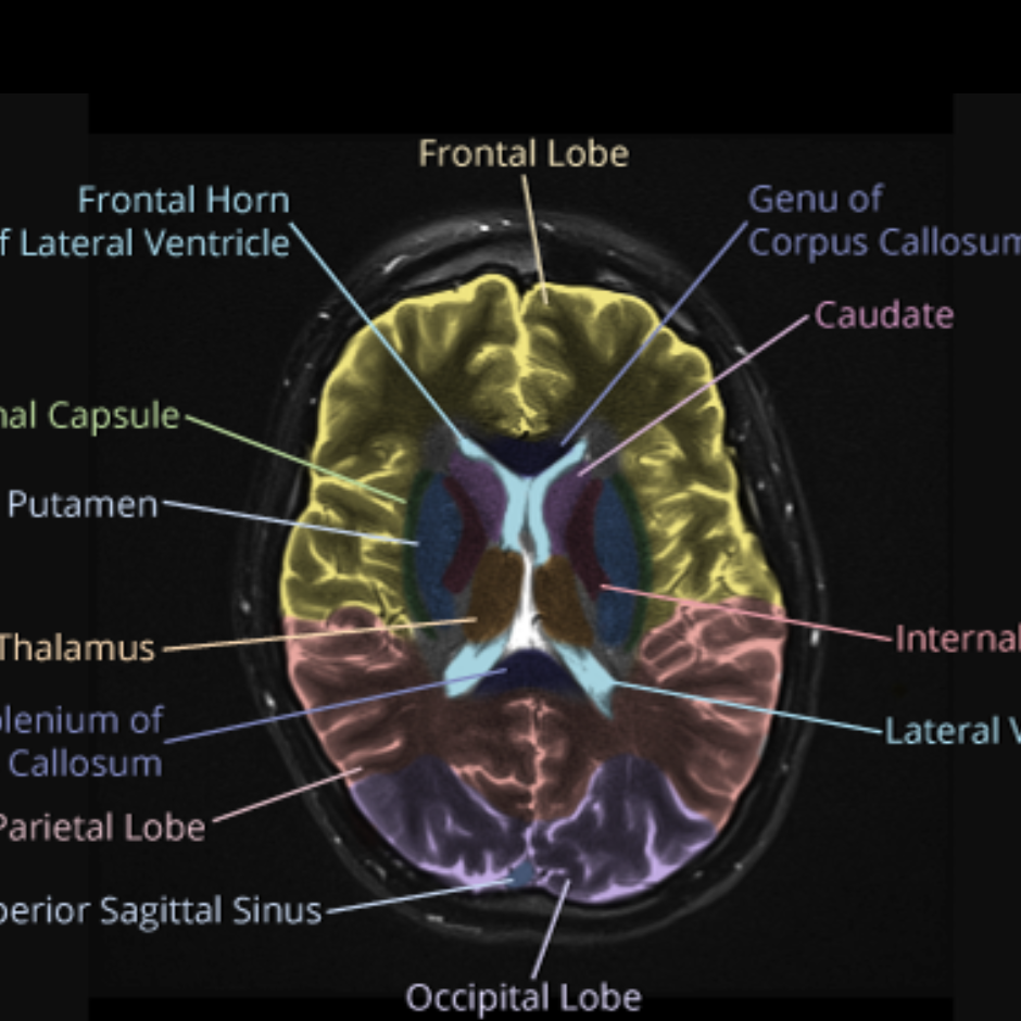Mri Sectional Anatomy Of Brain Brain Anatomy Mri Frontal Lobe | Images ...