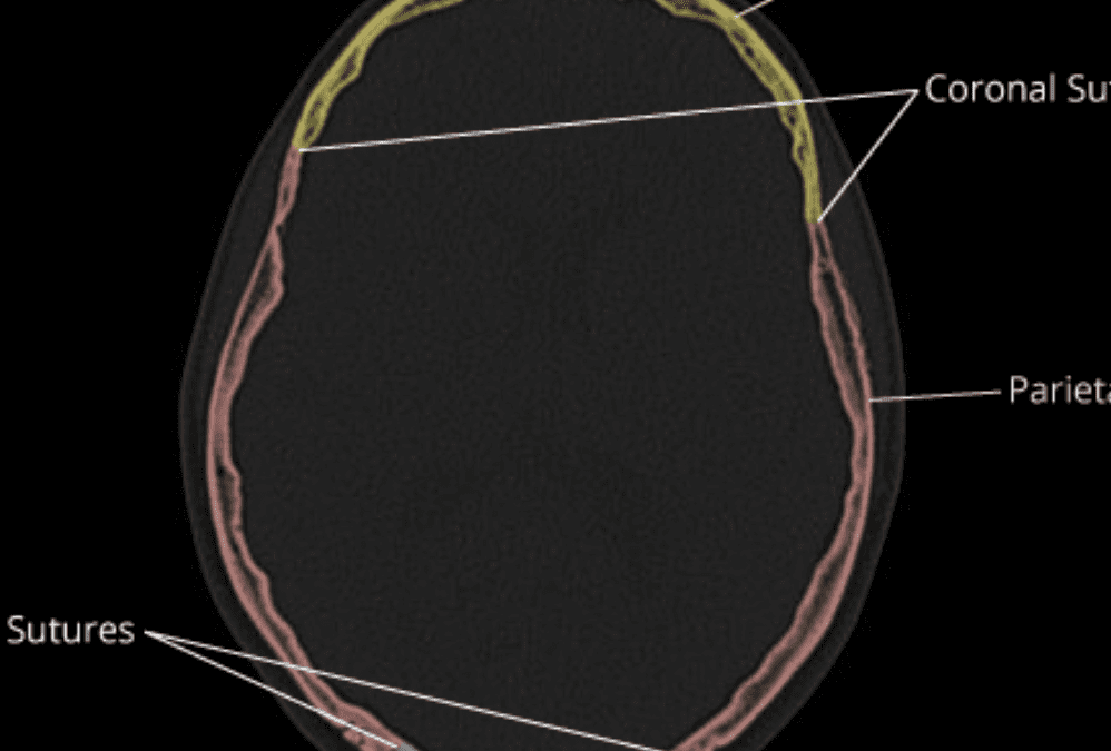 Calvarial Anatomy on CT